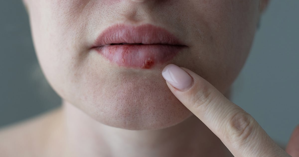 Después de casi treinta años, llega un antiviral oral que rompe la resistencia del herpes en pacientes con defensas comprometidas